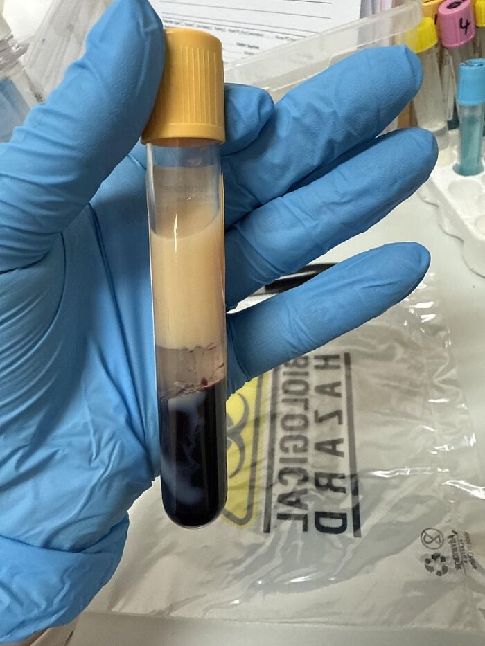 Hand wearing blue glove holding test tube with blood sample showing plasma and red blood cells in medical setting.