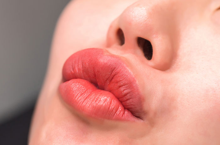 Close-up of swollen lips and nose showing signs of botched plastic surgery with uneven texture and redness.