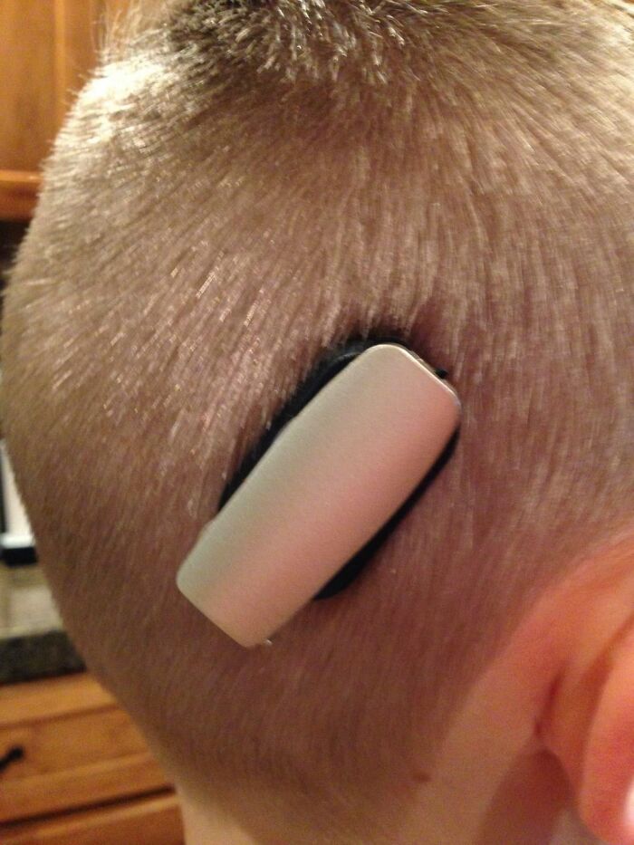 Dispositivo médico extraño colocado en la cabeza de un niño con corte de cabello corto, imagen médica inquietante compartida online.