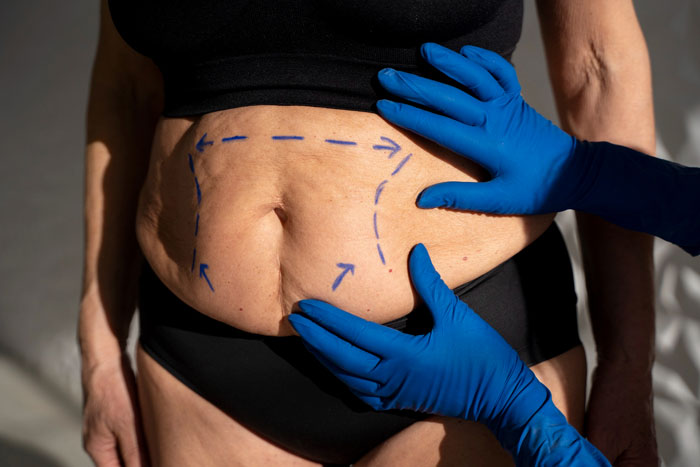 Close-up of woman&rsquo;s abdomen marked for plastic surgery after weight loss, with hands in blue gloves assessing the area.