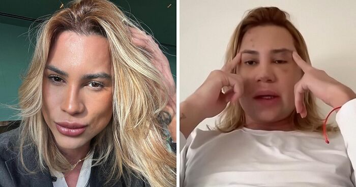 Influencer Passes Away After Exposing Complications From Popular ‘Fox Eyes’ Surgery