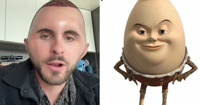 “I Literally Look Like An Egg”: TikToker’s Hair Transplant Recovery Has Everyone Cracking Up