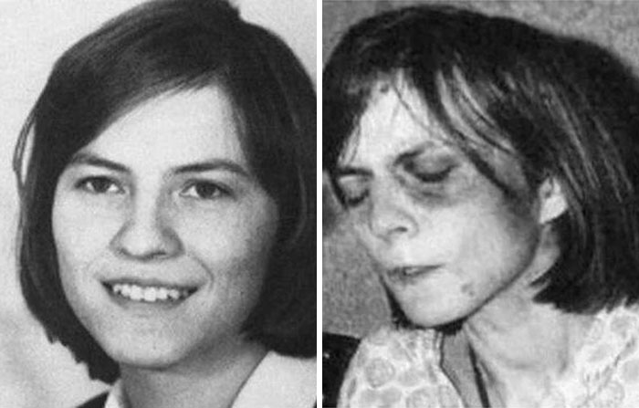 Black and white side-by-side photos of a young woman before and after an injury, illustrating a still remains undiscovered mystery.