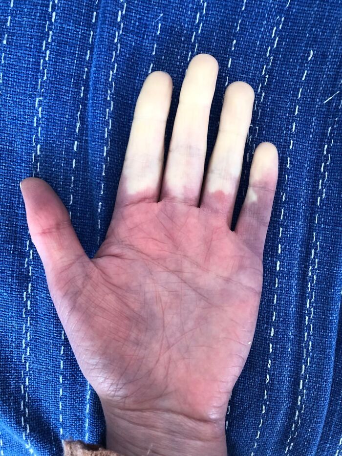 Mano con dedos pálidos mostrando signos médicos raros y desconcertantes en publicaciones médicas compartidas online.