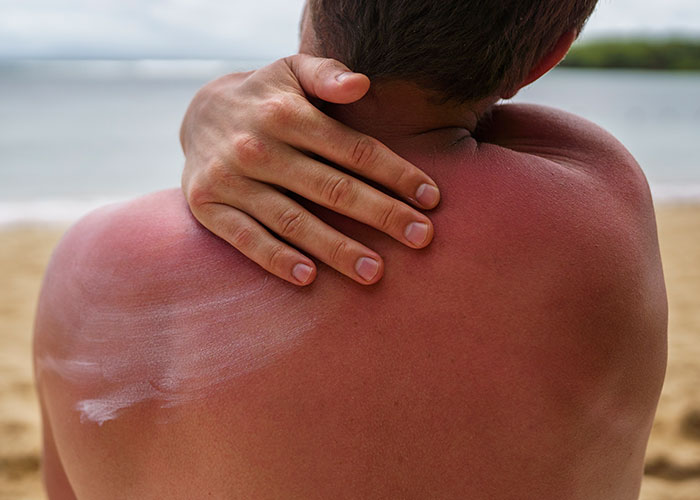 Person with sunburned back applying lotion, illustrating childhood mistakes that make people cringe today.