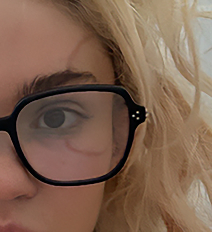 Close-up of a person with blonde hair wearing black glasses and a visible ringworm face tattoo on the cheek.
