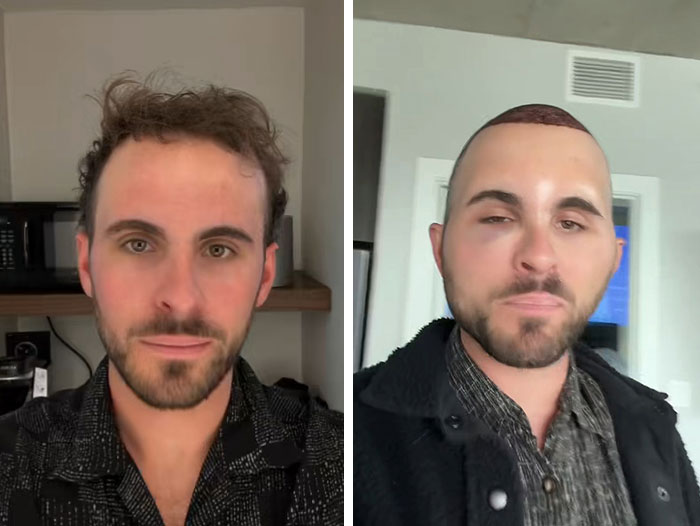 TikToker showing before and after photos of hair transplant recovery with a closely shaved head and new hair growth.