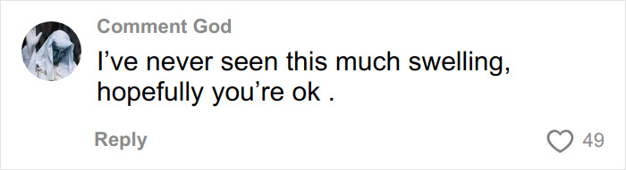 Comment on TikTok post about hair transplant recovery, expressing concern over swelling and hoping for a good outcome.