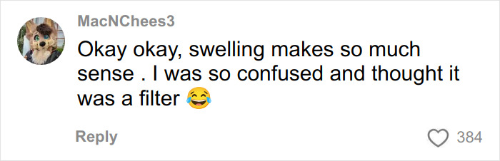 Comment on TikToker's hair transplant recovery video mentioning swelling and confusion about a filter with a laughing emoji.