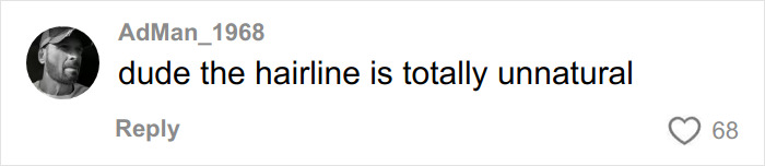 Comment on TikTok post reacting to hair transplant recovery, mentioning the hairline looks unnatural.
