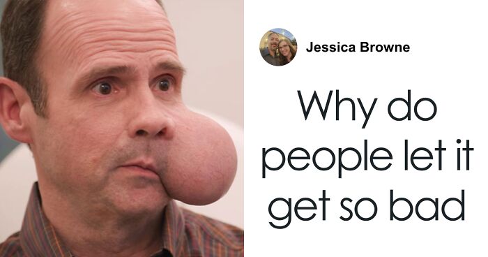 After Man Waits 7 Years To Remove 4-Lb. Face Tumor, Doctor Gives Him Fatal Warning