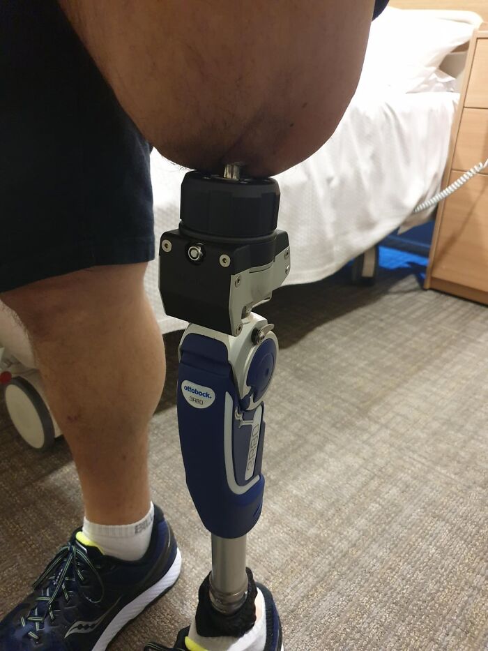 Prótesis de pierna azul y negra usada por persona con amputación, imagen relacionada con posts médicos inquietantes y extraños.