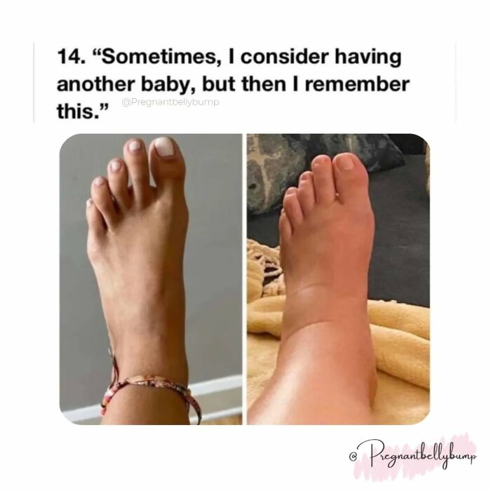 Comparison of a normal foot and a swollen foot, illustrating the chaos and challenges of parenting with 50% love and 0% sleep.