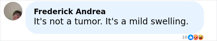 Comment by Frederick Andrea stating it's not a tumor but a mild swelling in a social media post about face tumor help.