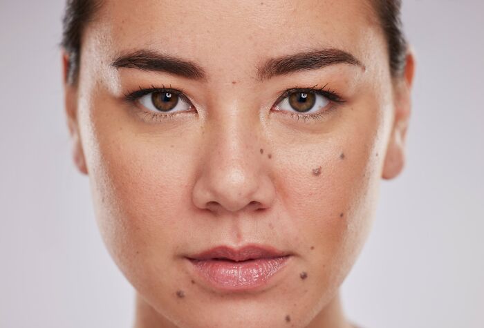 Close-up of a woman’s face showing skin conditions related to medical problems far worse than people think