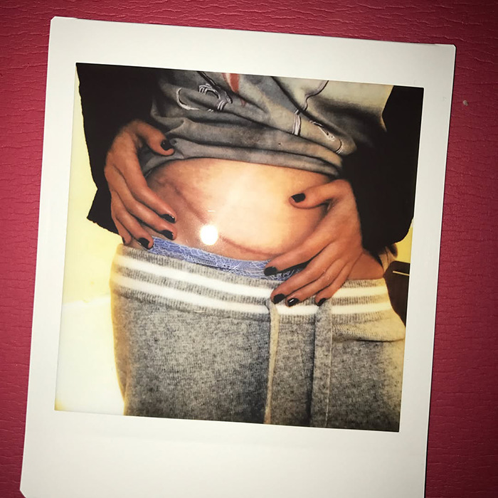 Close-up photo of a person showing a kidney donor scar amid Selena Gomez wedding claims. Close-up photo of a person showing a kidney donor scar amid Selena Gomez wedding claims.