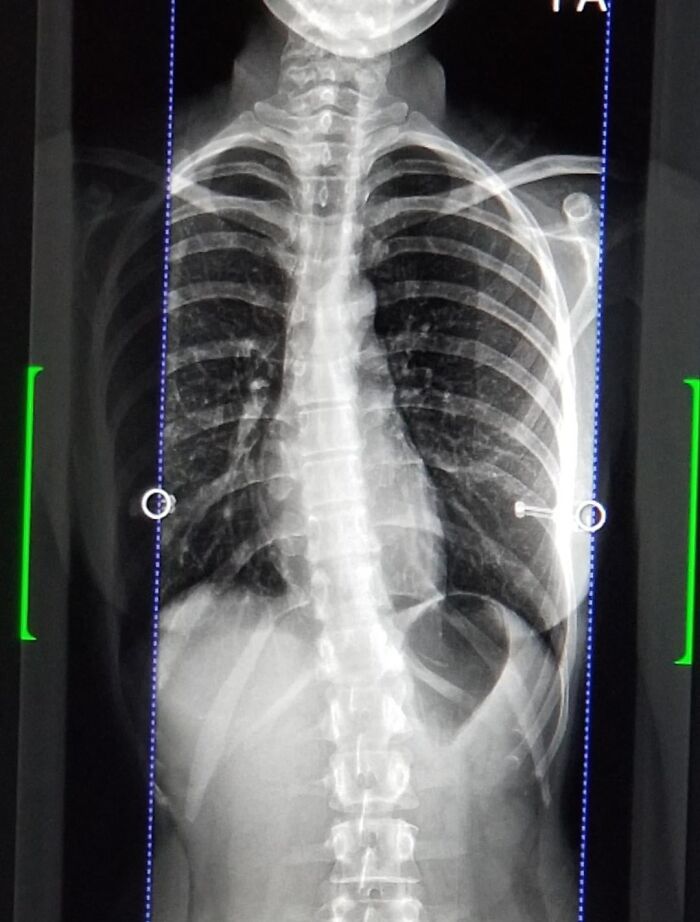 X-ray image showing human ribcage and spine, relevant to medical posts that are fascinating and deeply unsettling.