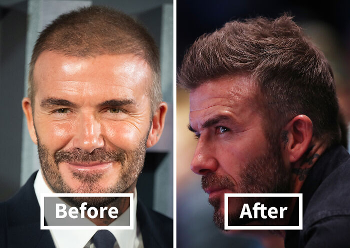 Before and after photos of a celebrity showing noticeable improvement after hair transplants with fuller hair and styled look.