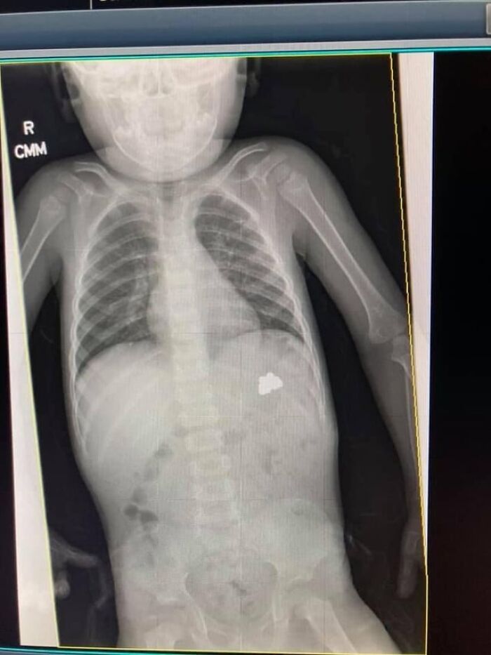 X-ray image of a child's torso showing skeletal structure and an unusual foreign object, relevant to medical posts.