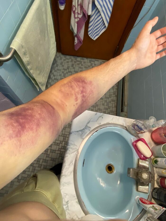 Severe bruising on a forearm in a bathroom setting, illustrating unsettling medical conditions and injuries.