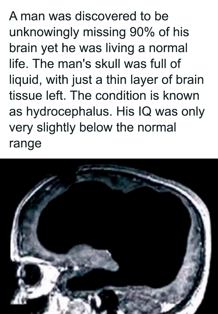MRI scan showing hydrocephalus with 90% of brain missing, shared on an IG page with daily facts and interesting stories.