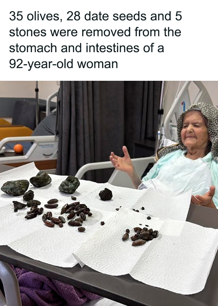92-year-old woman in hospital bed with 35 olives and 28 date seeds removed, shared by popular daily facts and stories IG page