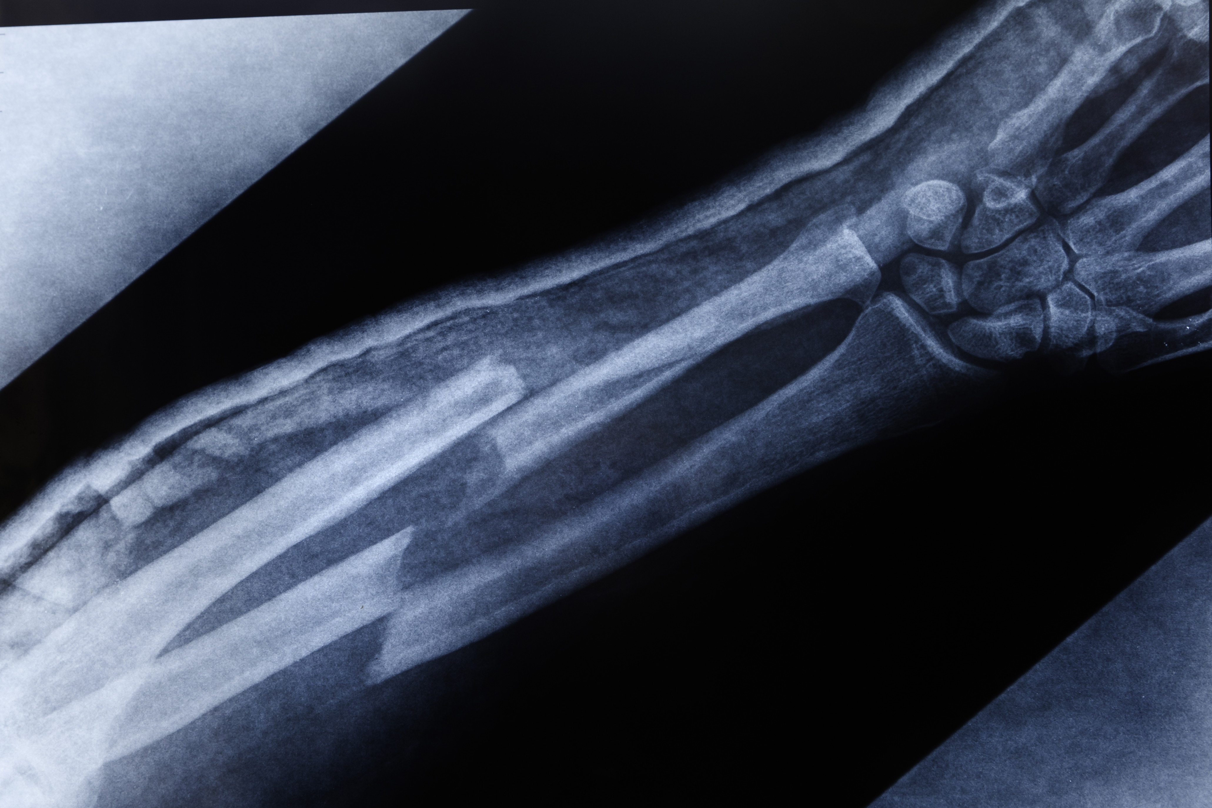 X-ray image showing a broken forearm bone, illustrating the broken bone theory discussed in the TikTok trend.