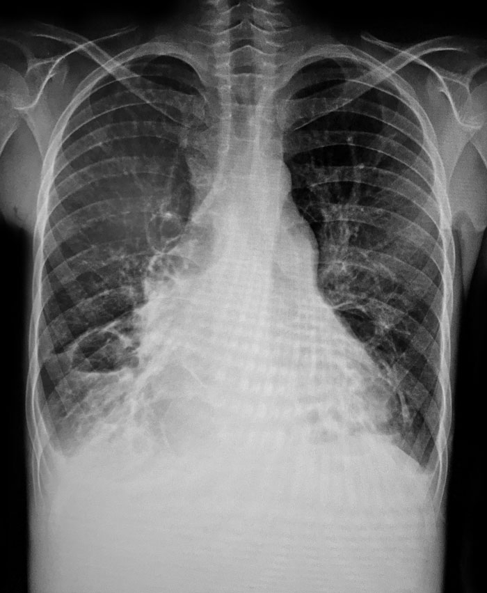 X-ray image showing ribcage and lungs with eerie details, capturing creepy and terrifying moments in urban exploration.