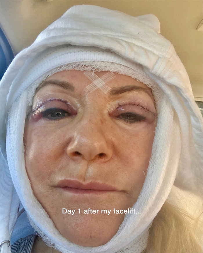 Close-up of a woman showing her aging progress one day after getting a facelift at 70 years old with visible stitches.