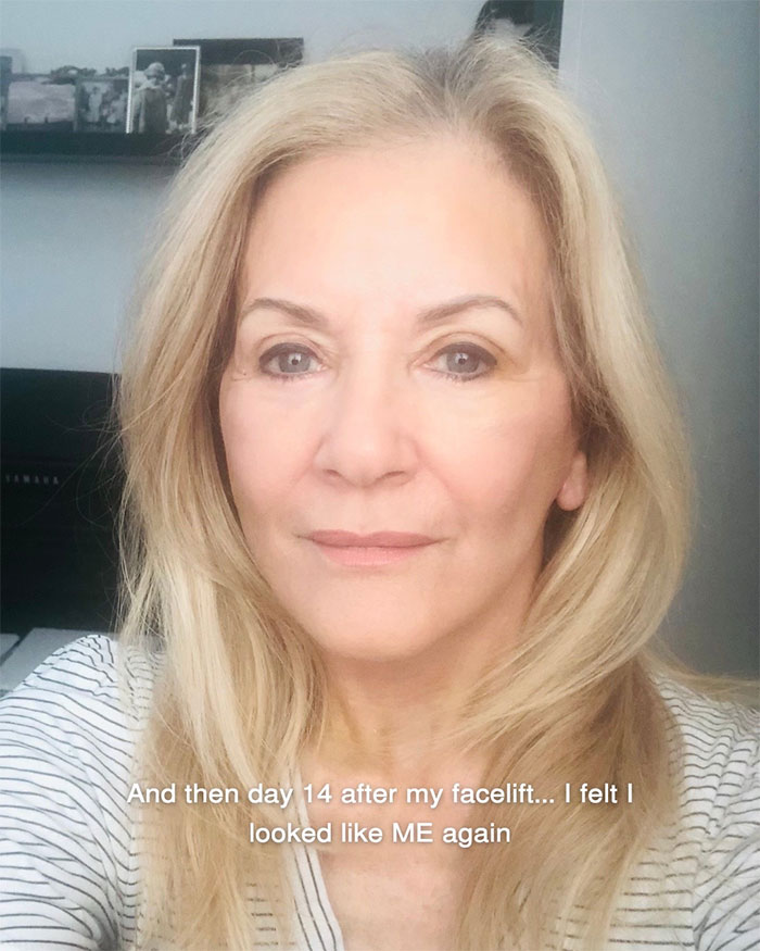 Woman showing aging progress and her appearance 14 days after facelift at 70 years old with natural look and long blonde hair.