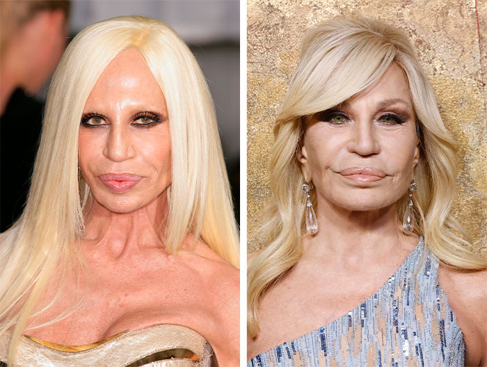 Side-by-side photos of two women showcasing facelift results highlighting warning signs behind facelift craze from a surgeon’s view.