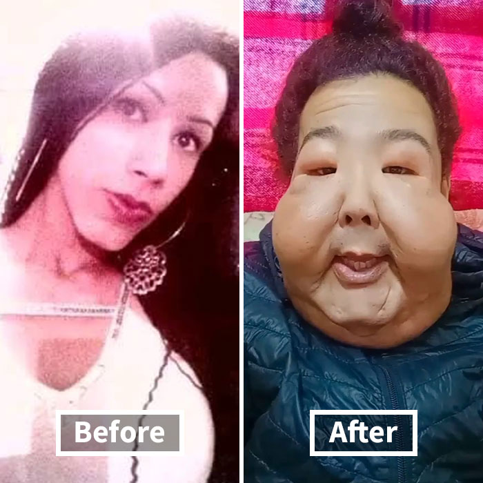 Before and after images showing influencer disfigured in botched plastic surgery undergoing treatment to restore her look.