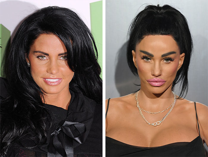 Side-by-side comparison of a woman before and after facelift surgery showing signs of cosmetic changes.