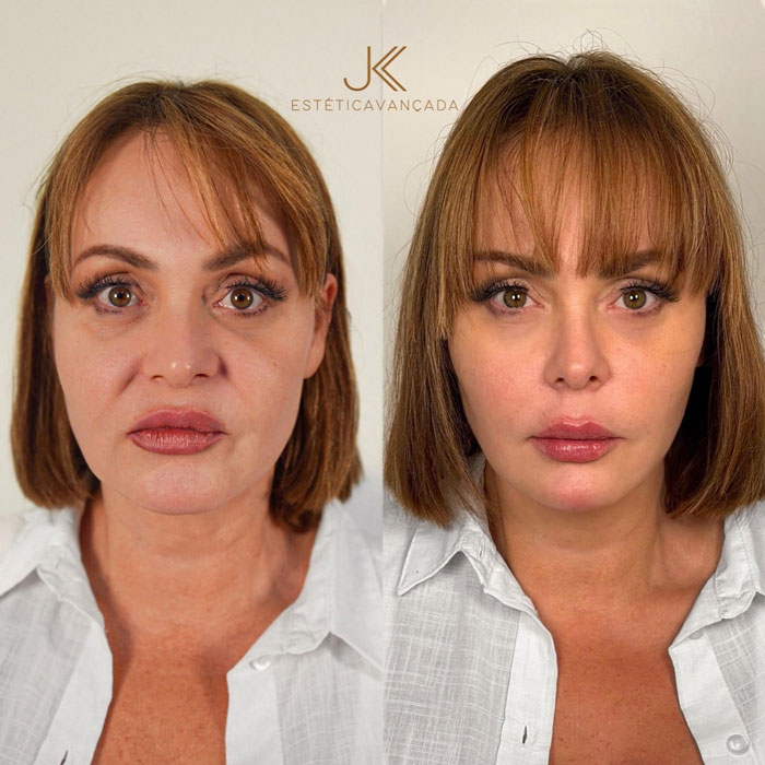 Before and after plastic surgery pictures of actress shared by clinic showing unrecognizable facial transformation and divided fans.