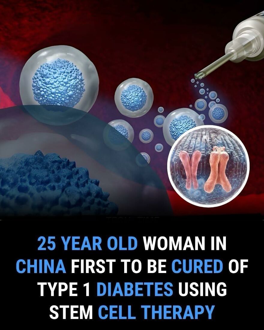 Stem cell therapy curing type 1 diabetes in a 25-year-old woman, highlighting medical facts about new treatments.