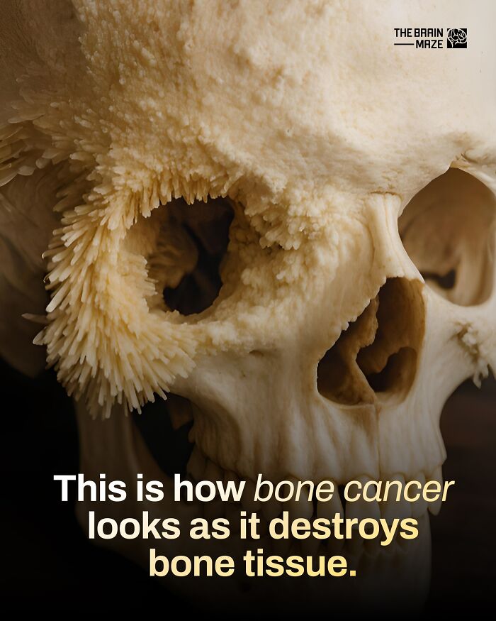 Close-up of a human skull showing bone cancer damage, illustrating incredible facts about the human body and bone tissue destruction.
