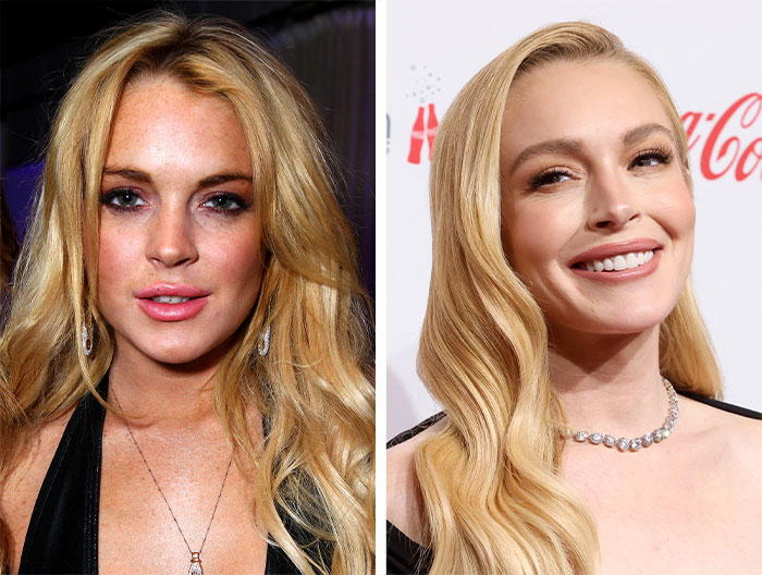 Before and after comparison of a woman’s facelift showing warning signs behind the popular facelift craze from a surgeon’s view