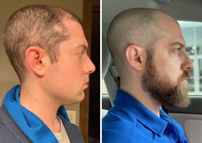 Side-by-side before-and-after photos showing a man’s stunning transformation and reinvented appearance with a shaved head and beard.