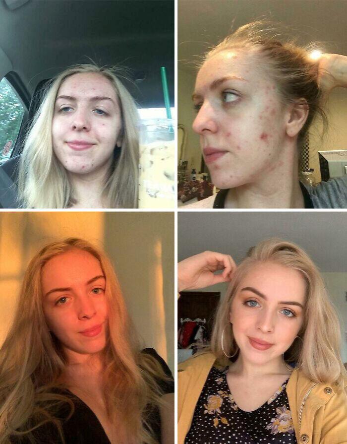 Collage showing stunning before-and-after transformation of a young woman with improving skin and confidence over time.