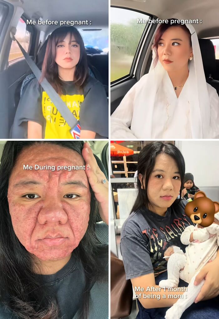 Four photos showing a mom before pregnancy, during pregnancy with skin changes, and after one month of being a mom holding her baby.