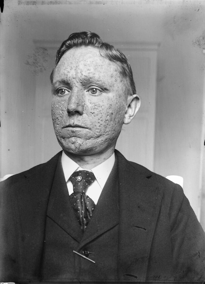 Black and white historical photo of a man with severe facial scars wearing a suit, showcasing a unique historical moment.