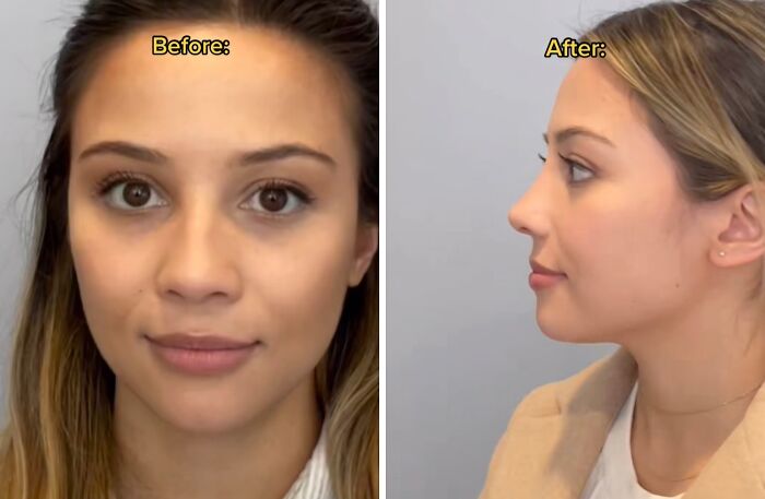 Before and after photos of a woman showing results of plastic surgery as part of people who changed and shared online.
