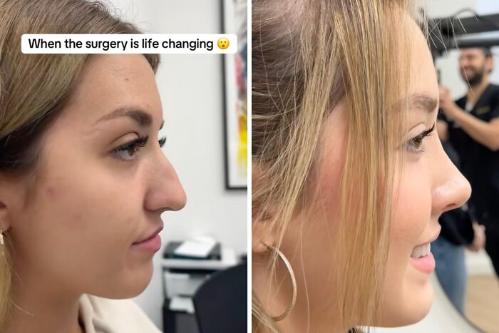 Side-by-side before and after images showing a woman’s plastic surgery transformation and improved facial features.