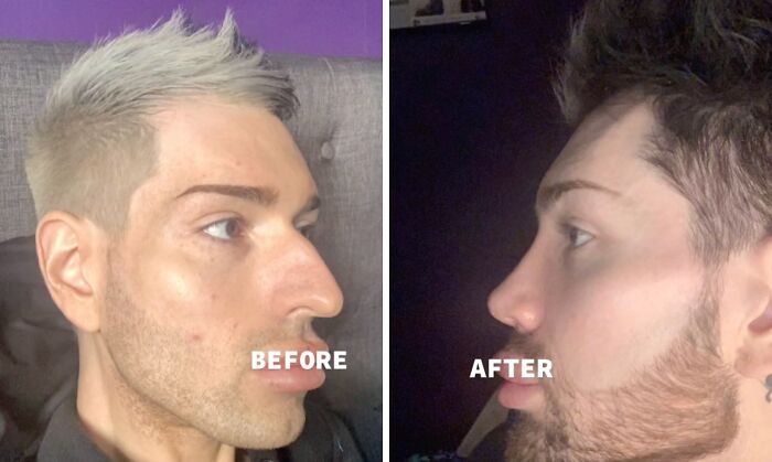 Side-by-side before and after photos of a man showcasing results of plastic surgery transformation shared online.