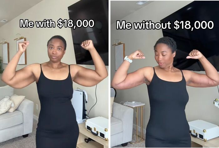 Before and after comparison of a woman showing changes in arm appearance related to plastic surgery results.