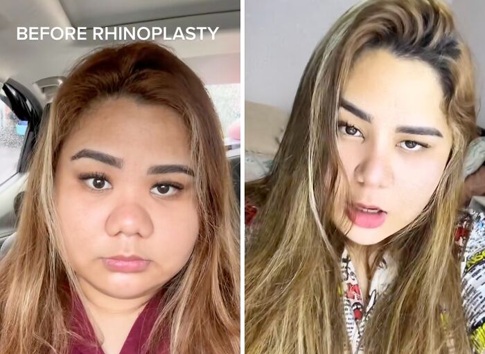 Before and after plastic surgery results showing a woman’s rhinoplasty transformation shared online by people who changed themselves.