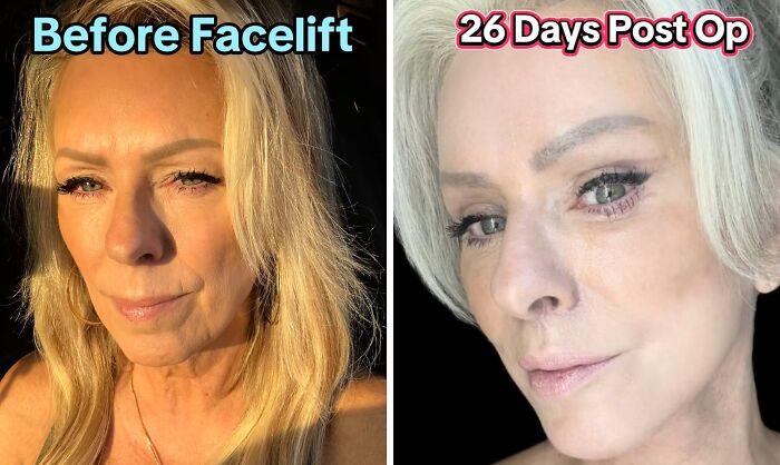 Side-by-side before and after photos of a woman showing facelift results 26 days post plastic surgery.