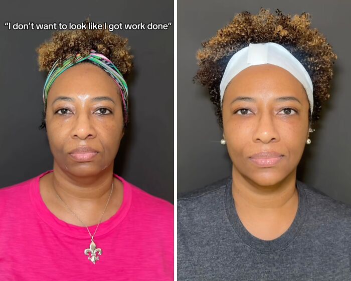 Before and after images of a woman showing natural results from plastic surgery transformation shared online.