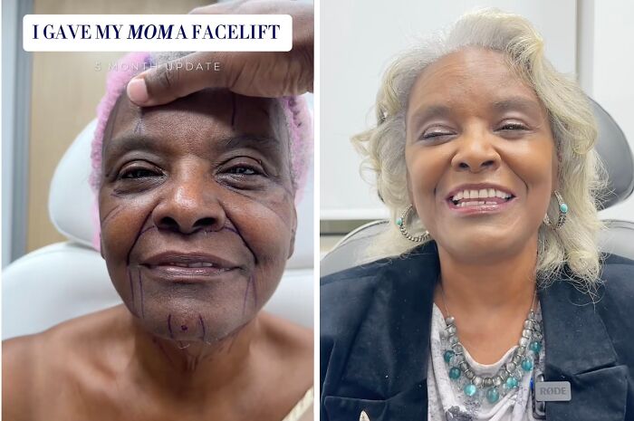 Before and after facelift results showing a woman who decided to change with the help of plastic surgery online.