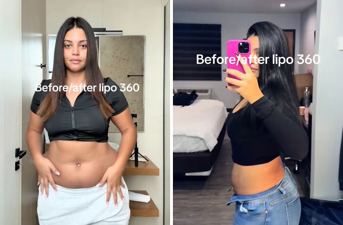 Before and after lipo 360 plastic surgery results shown by a woman highlighting body transformation progress.